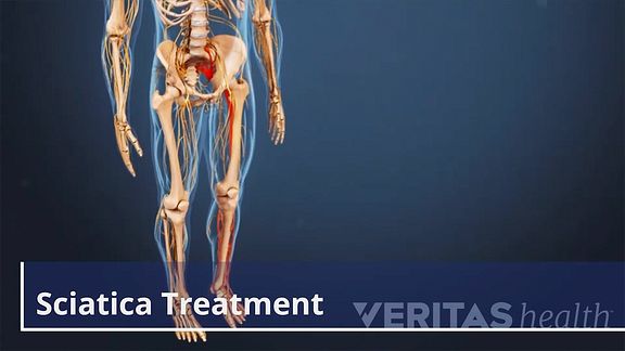 how to alleviate sciatica pain at work